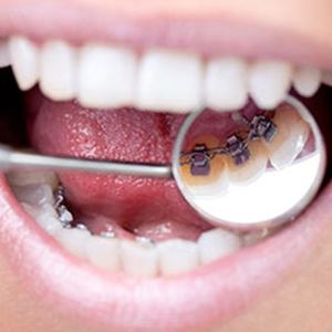 Ortodontik Tedavi Nedir ?