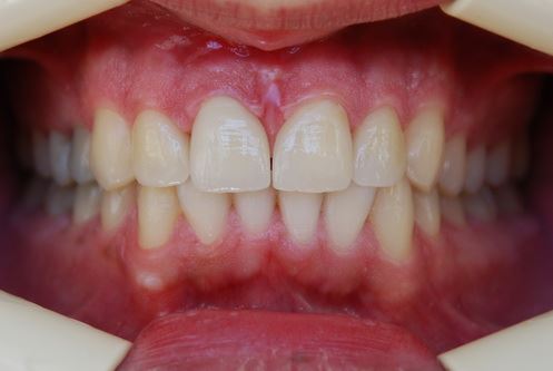 Empress / e.max press