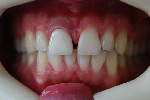 Empress / e.max press